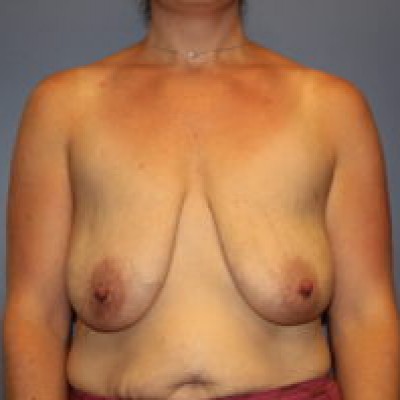 Before Image: Breast Reduction - front