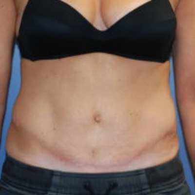 After Image: Tummy Tuck (Abdominoplasty) - front