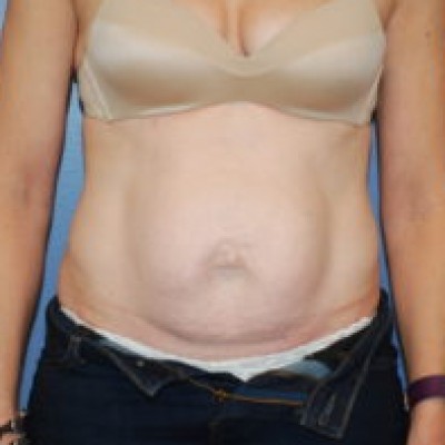 Before Image: Tummy Tuck (Abdominoplasty) - front