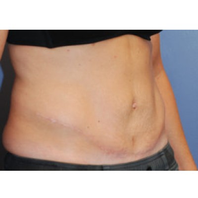 After Image: Tummy Tuck (Abdominoplasty) - other
