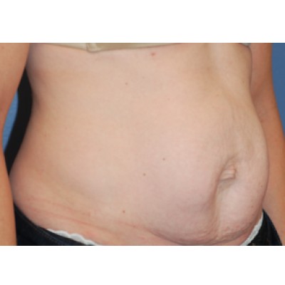 Before Image: Tummy Tuck (Abdominoplasty) - other