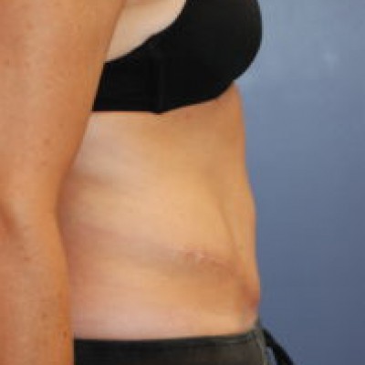 After Image: Tummy Tuck (Abdominoplasty) - other