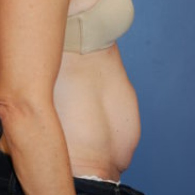 Before Image: Tummy Tuck (Abdominoplasty) - other