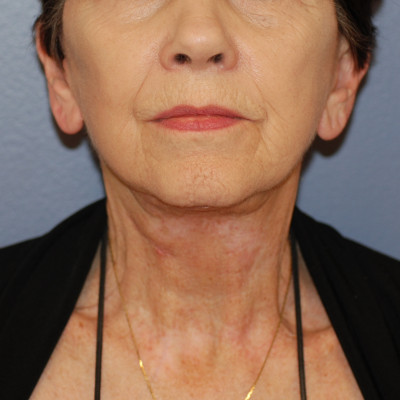 After Image: Necklift - front
