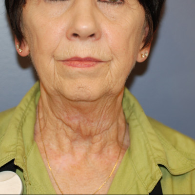 Before Image: Necklift - front
