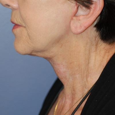 After Image: Necklift - front