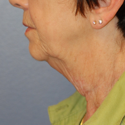 Before Image: Necklift - front