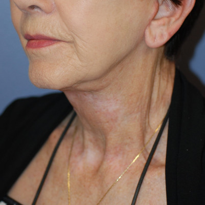 After Image: Necklift - front
