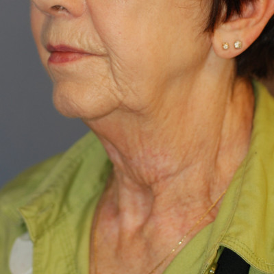Before Image: Necklift - front