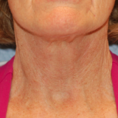 After Image: Necklift - front