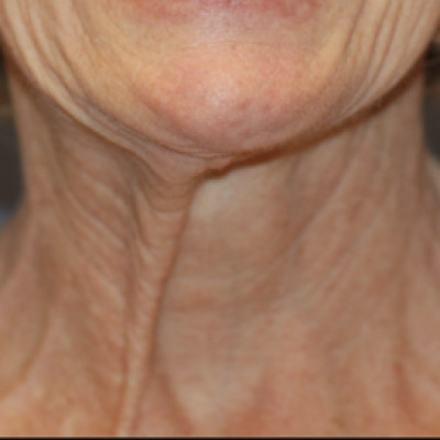 Before Image: Necklift - front