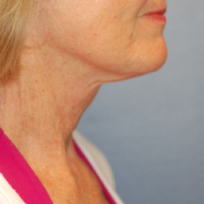 After Image: Necklift - right-side