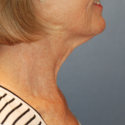 Before Image: Necklift - right-side