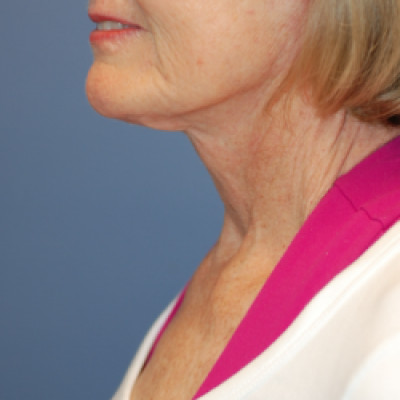 After Image: Necklift - left-side