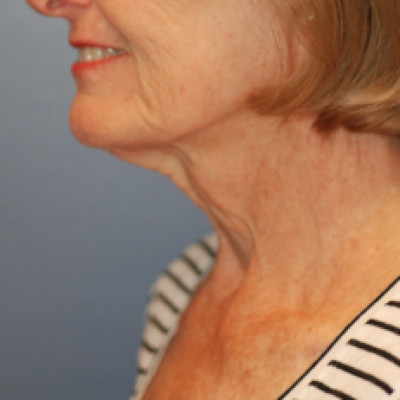 Before Image: Necklift - left-side