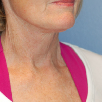 After Image: Necklift - right-front-oblique