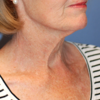 Before Image: Necklift - right-front-oblique