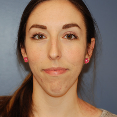 Before Image: Rhinoplasty - front