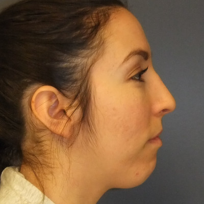 After Image: Rhinoplasty - other
