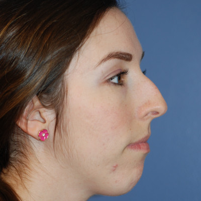 Before Image: Rhinoplasty - other