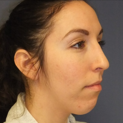 After Image: Rhinoplasty - other