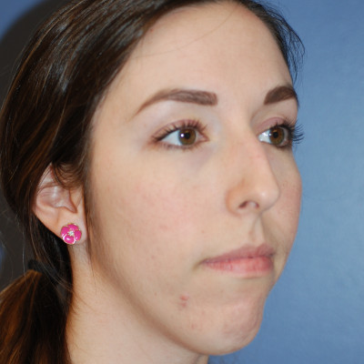 Before Image: Rhinoplasty - other