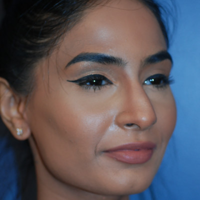 After Image: Rhinoplasty - other