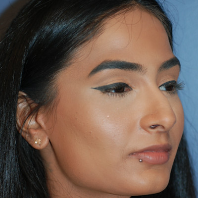 Before Image: Rhinoplasty - other