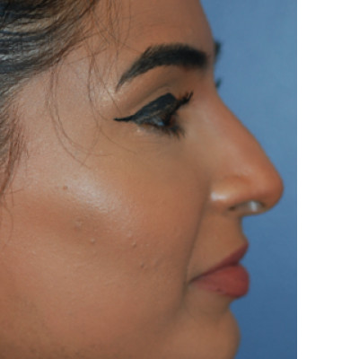 After Image: Rhinoplasty - right-side