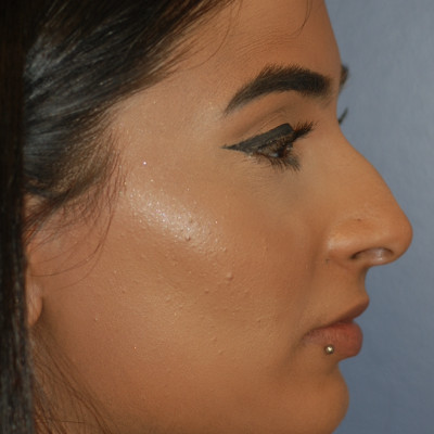 Before Image: Rhinoplasty - right-side