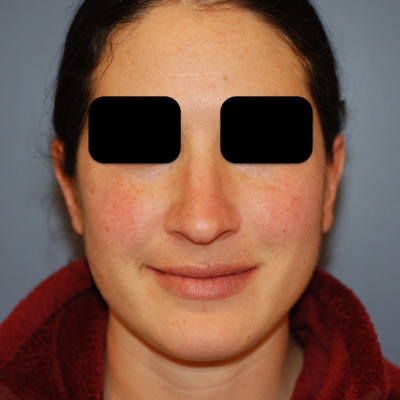 Before Image: Rhinoplasty - front