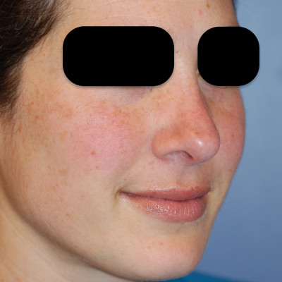 After Image: Rhinoplasty - other