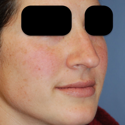 Before Image: Rhinoplasty - other