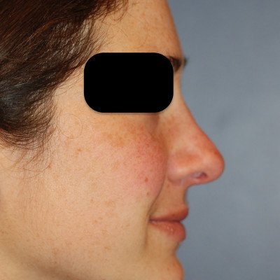 After Image: Rhinoplasty - other