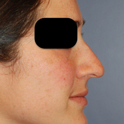 Before Image: Rhinoplasty - other