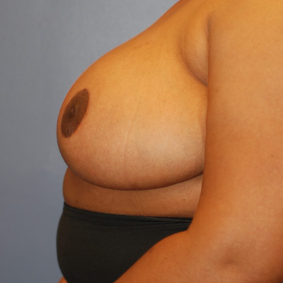 After Image: Breast Reduction - other