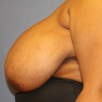 Before Image: Breast Reduction - other