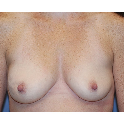 Before Image: Single Staged Implant Based Breast Reconstruction - front