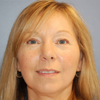 After Image: Rhinoplasty - front