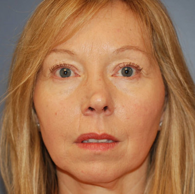 Before Image: Rhinoplasty - front