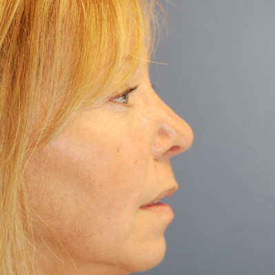 After Image: Rhinoplasty - other