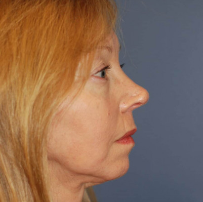 Before Image: Rhinoplasty - other