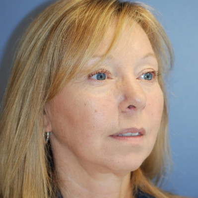After Image: Rhinoplasty - right-front-oblique