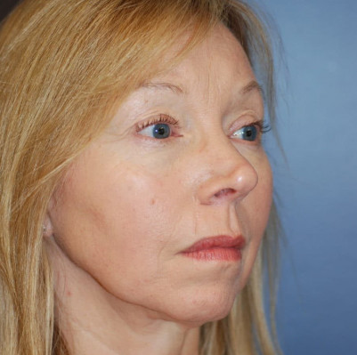 Before Image: Rhinoplasty - right-front-oblique