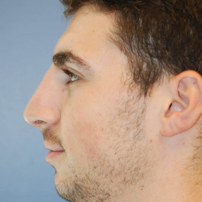 After Image: Rhinoplasty - other