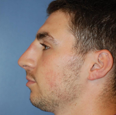 Before Image: Rhinoplasty - other