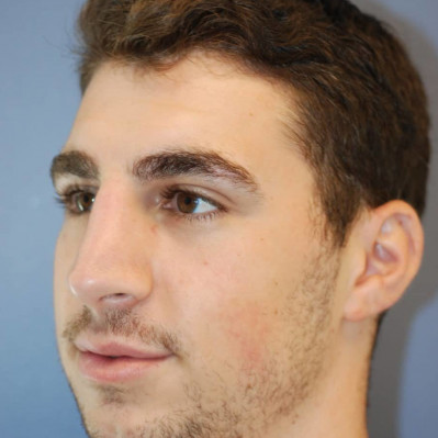 After Image: Rhinoplasty - other