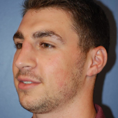 Before Image: Rhinoplasty - other