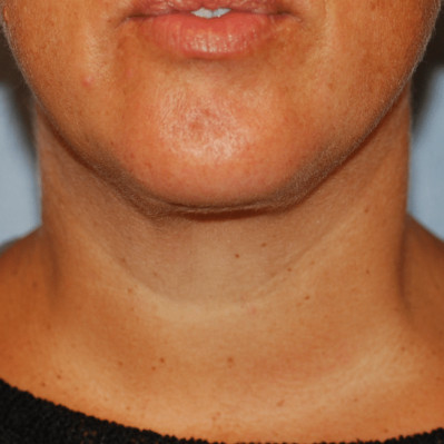 After Image: Necklift - front
