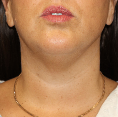 Before Image: Necklift - front